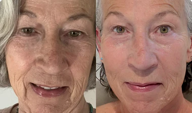 Before-and-after skin comparison for Joan, age 64