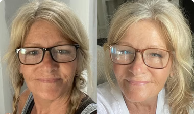 Before-and-after skin comparison for Karen, age 55