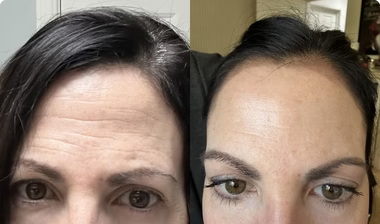 Before-and-after skin comparison for Lisa, age 50