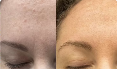 Before-and-after skin comparison for Mel, age 44